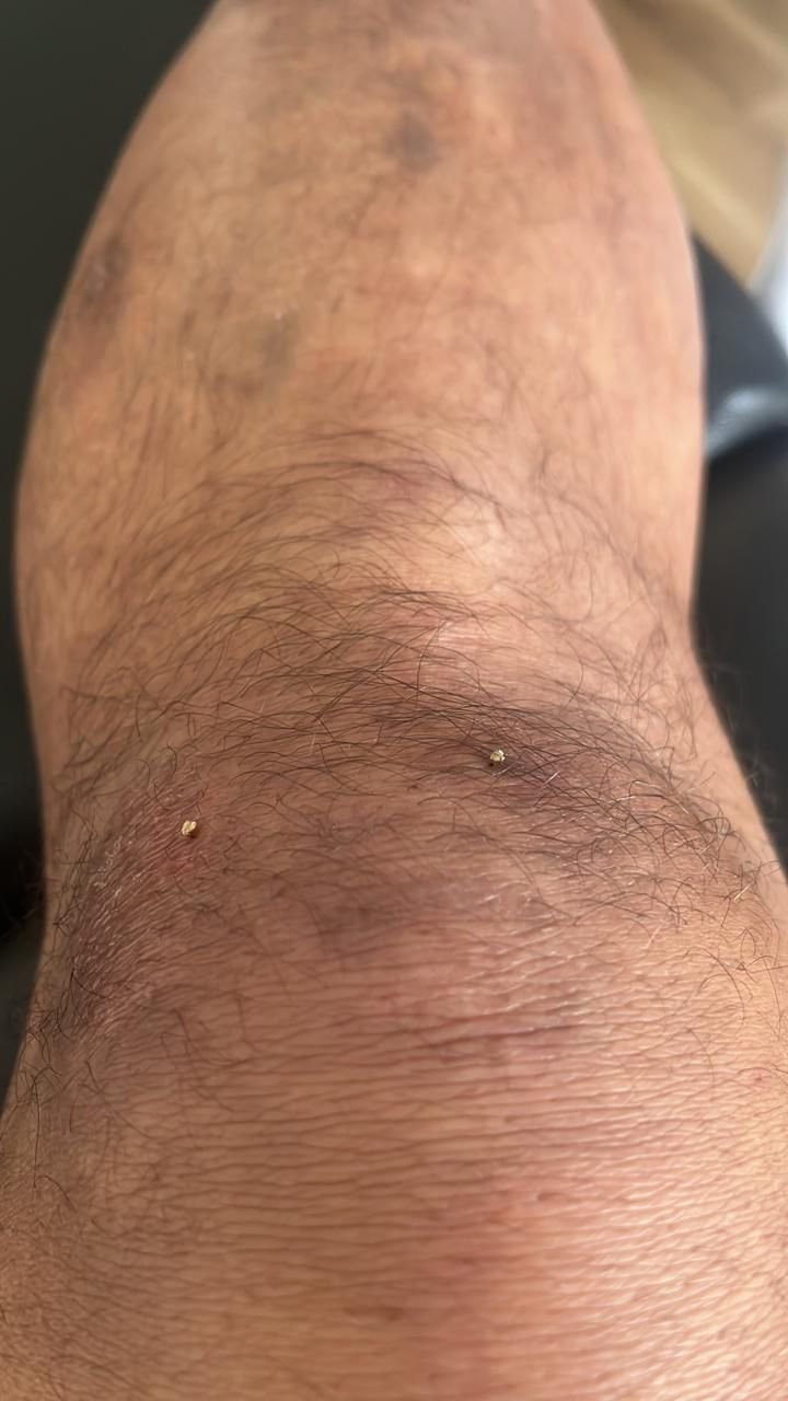 Sesión de apiterapia en rodilla